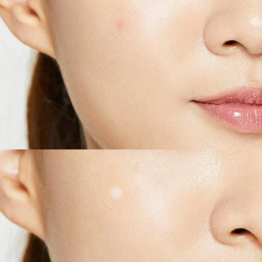 Acne Pimple Master Patches - 24st - Image 3