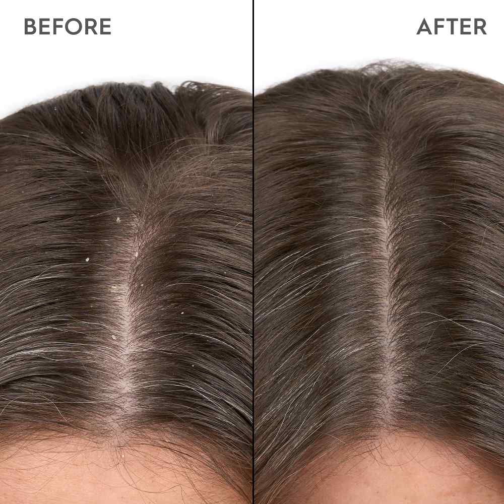 Anti-Dandruff Scalp Serum - 100ml - Image 4